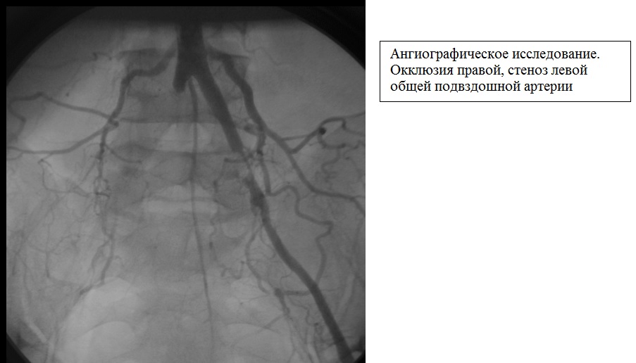 ангиографическое исследование - окклюзия правой, стеноз левой общей подвздошной артерии